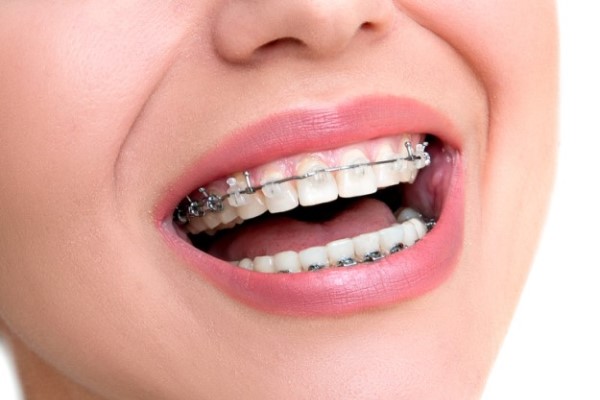 When Can A Child See A Braces Specialist?