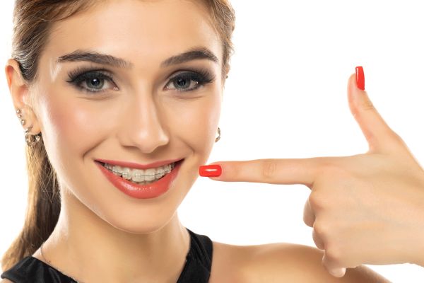 How Long Do Cosmetic Braces Take To Straighten Teeth?